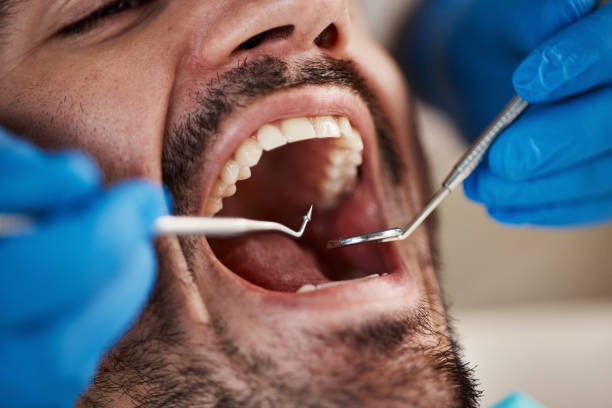 Best Emergency Wisdom Teeth Removal in Columbus, NC
